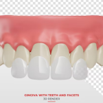 How Do I Extend The Life Of Veneers?