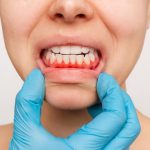 gum disease symptoms