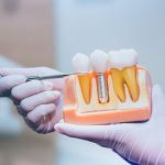 dental implant model showing stable implant supported denture replacement